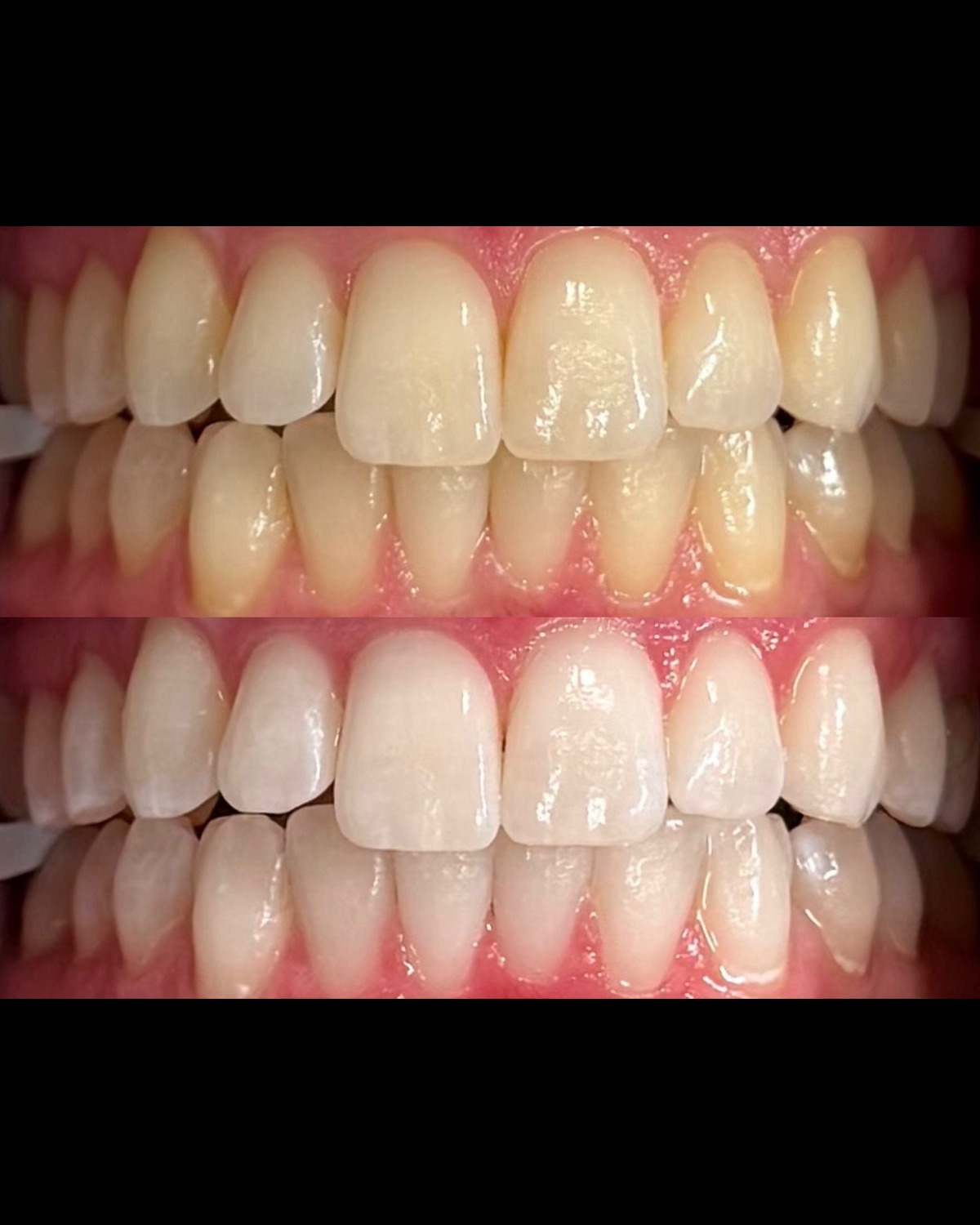 ORLA before and after whitening results